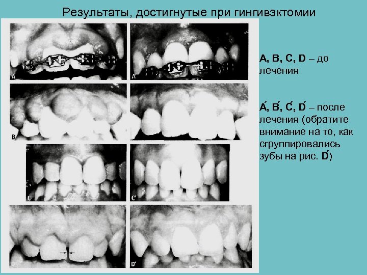 Результаты, достигнутые при гингивэктомии А, В, С, D – до лечения А , В