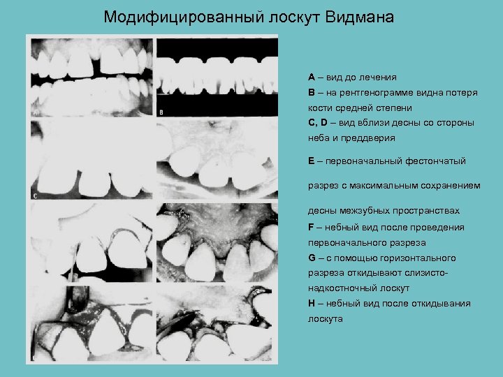 Модифицированный лоскут Видмана А – вид до лечения В – на рентгенограмме видна потеря