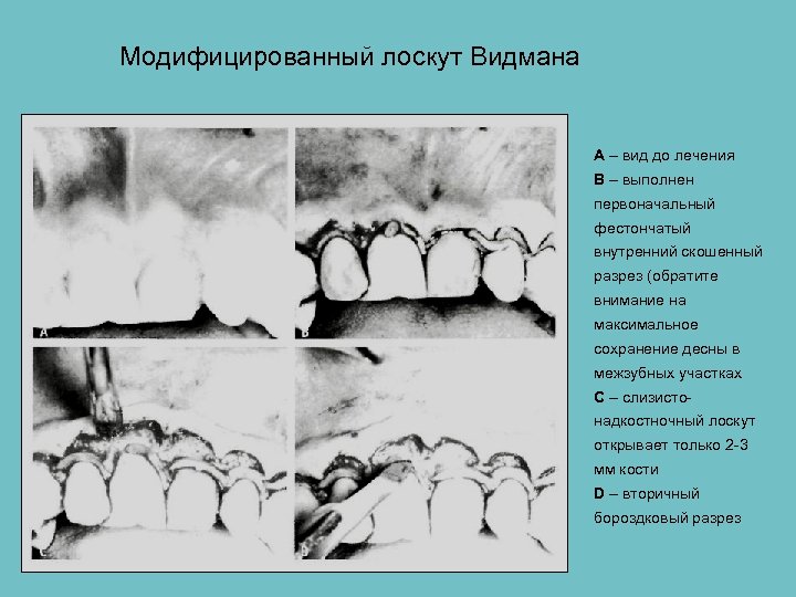 Модифицированный лоскут Видмана А – вид до лечения В – выполнен первоначальный фестончатый внутренний