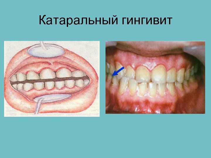 Пародонтит и гингивит презентация