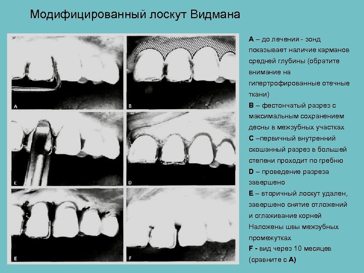 Модифицированный лоскут Видмана А – до лечения - зонд показывает наличие карманов средней глубины