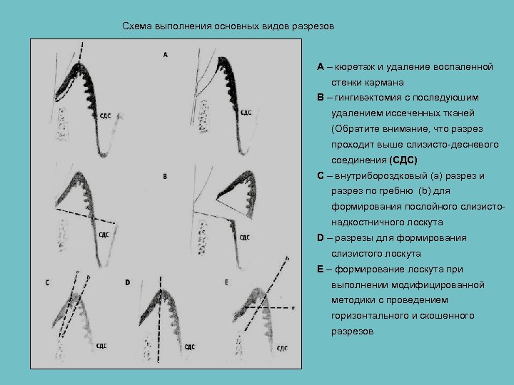 Схема выполнения основных видов разрезов А – кюретаж и удаление воспаленной стенки кармана В