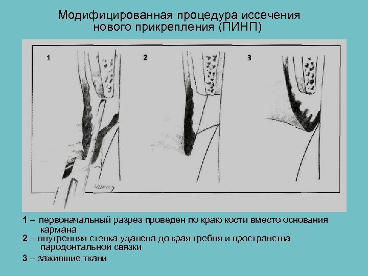 Модифицированная процедура иссечения нового прикрепления (ПИНП) 1 – первоначальный разрез проведен по краю кости