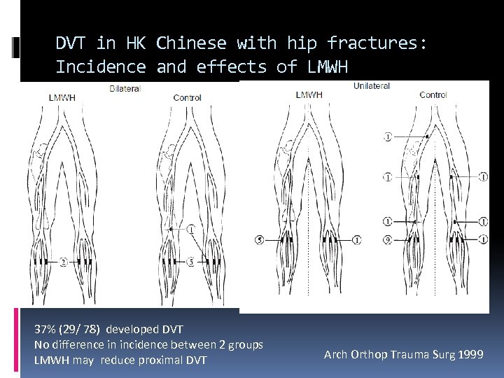 DVT in HK Chinese with hip fractures: Incidence and effects of LMWH 37% (29/