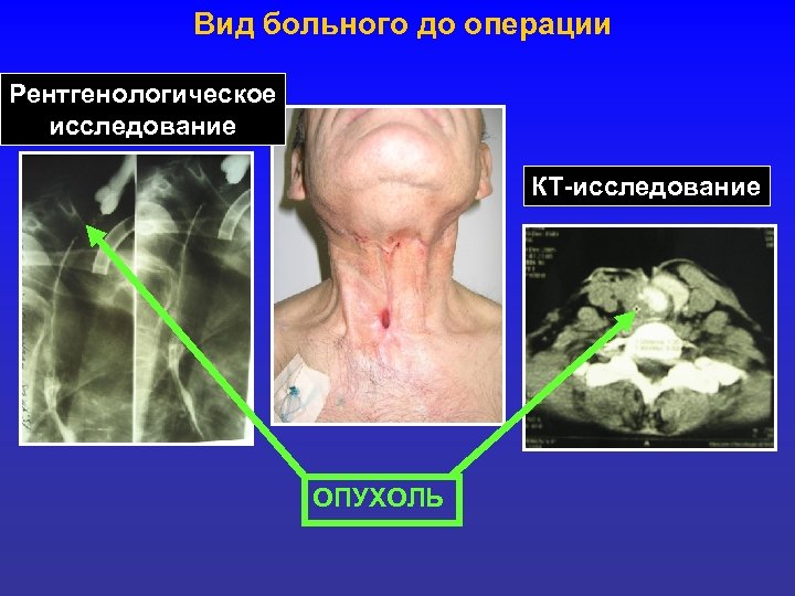 Вид больного до операции Рентгенологическое исследование КТ-исследование ОПУХОЛЬ 