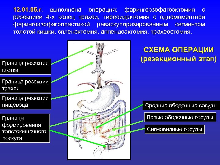 12. 01. 05. г. выполнена операция: фарингоэзофагоэктомия с резекцией 4 -х колец трахеи, тиреоидэктомия