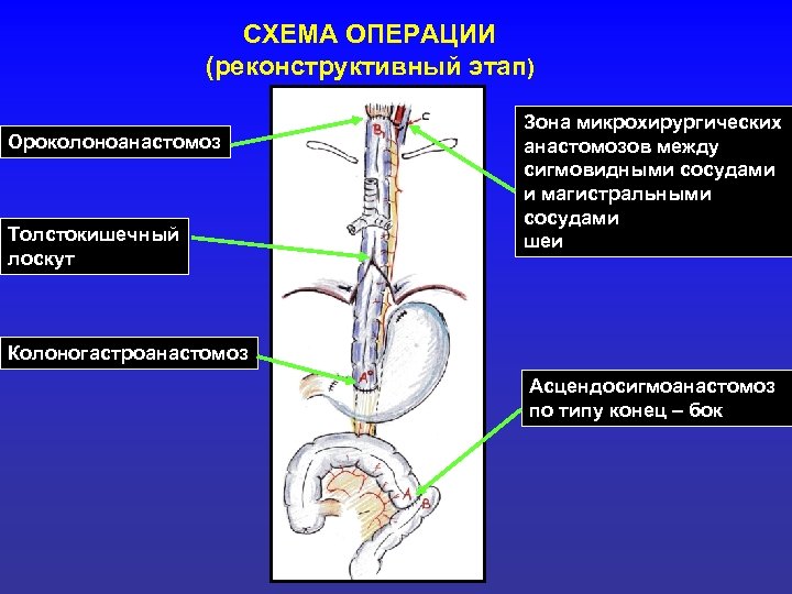 СХЕМА ОПЕРАЦИИ (реконструктивный этап) Ороколоноанастомоз Толстокишечный лоскут Зона микрохирургических анастомозов между сигмовидными сосудами и