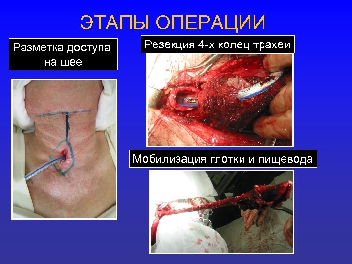 ЭТАПЫ ОПЕРАЦИИ Разметка доступа на шее Резекция 4 -х колец трахеи Мобилизация глотки и
