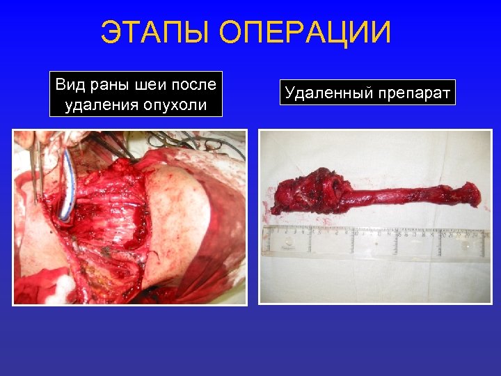 ЭТАПЫ ОПЕРАЦИИ Вид раны шеи после удаления опухоли Удаленный препарат 