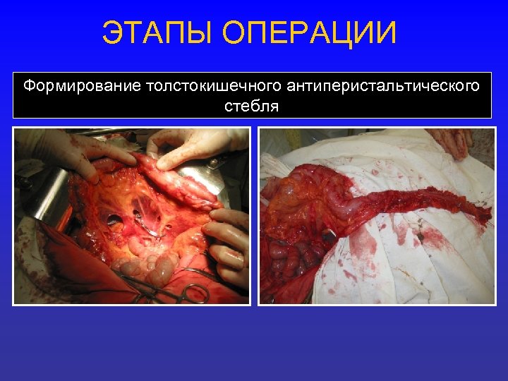 ЭТАПЫ ОПЕРАЦИИ Формирование толстокишечного антиперистальтического стебля 