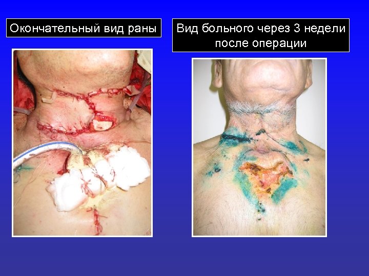 Окончательный вид раны Вид больного через 3 недели после операции 