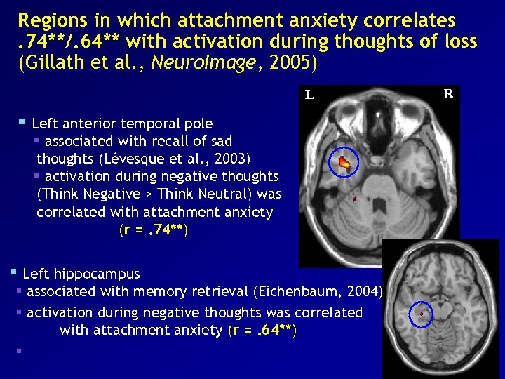 Regions in which attachment anxiety correlates. 74**/. 64** with activation during thoughts of loss