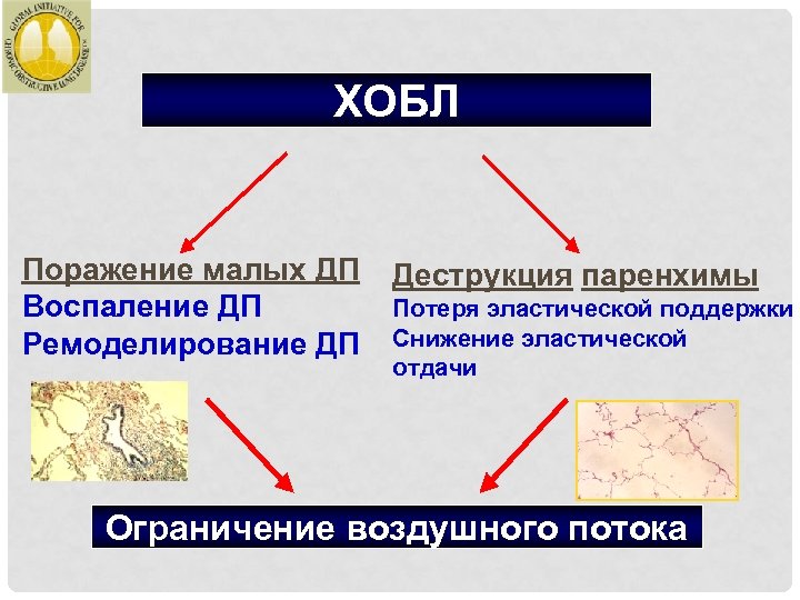 ХОБЛ Поражение малых ДП Воспаление ДП Ремоделирование ДП Деструкция паренхимы Потеря эластической поддержки Снижение