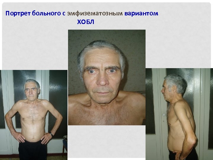 Портрет больного с эмфизематозным вариантом ХОБЛ 