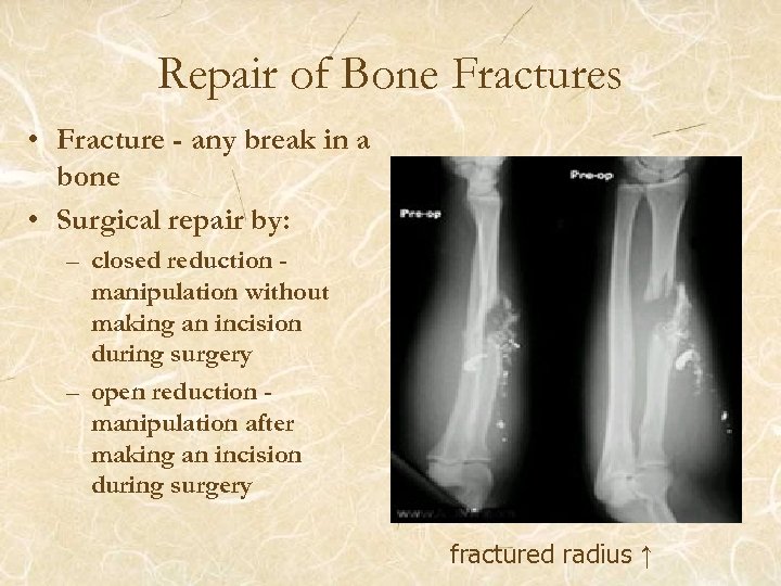 Repair of Bone Fractures • Fracture - any break in a bone • Surgical