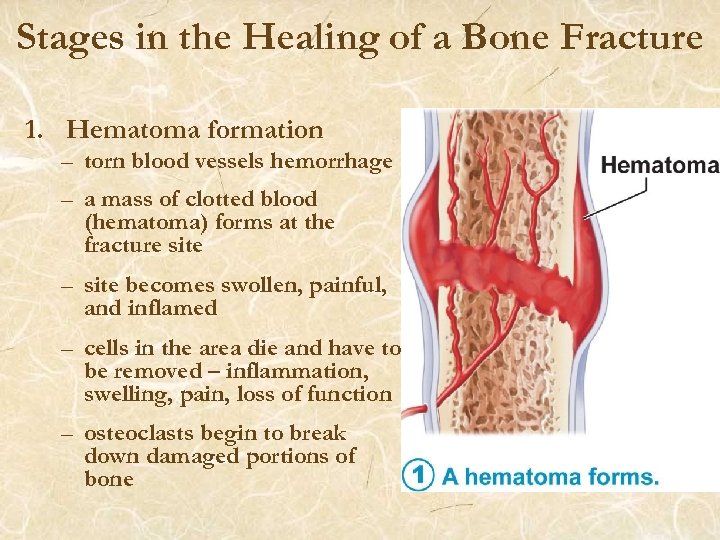 Stages in the Healing of a Bone Fracture 1. Hematoma formation – torn blood