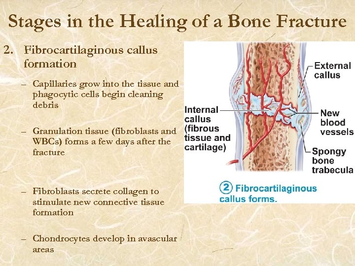 Stages in the Healing of a Bone Fracture 2. Fibrocartilaginous callus formation – Capillaries