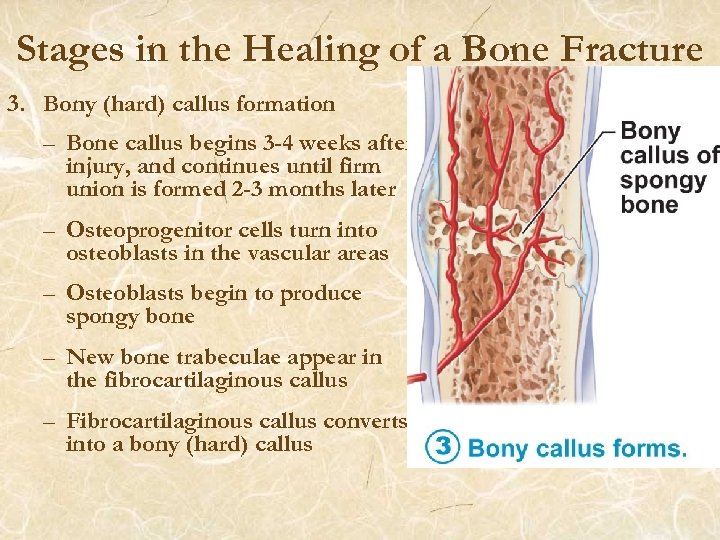 Stages in the Healing of a Bone Fracture 3. Bony (hard) callus formation –