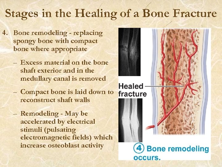 Stages in the Healing of a Bone Fracture 4. Bone remodeling - replacing spongy
