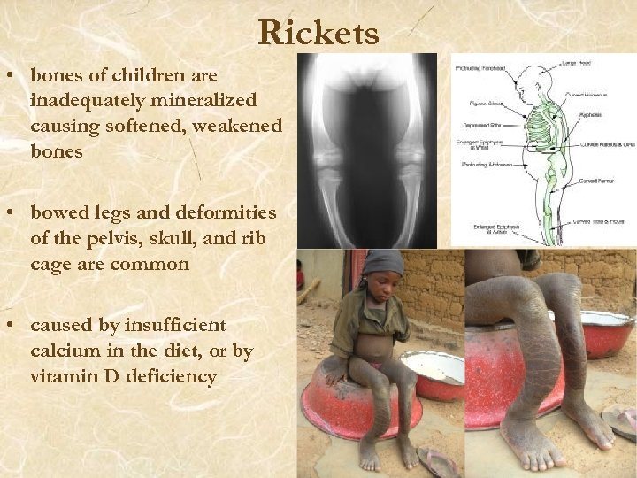 Rickets • bones of children are inadequately mineralized causing softened, weakened bones • bowed