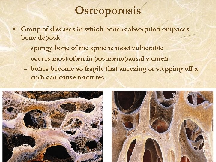Osteoporosis • Group of diseases in which bone reabsorption outpaces bone deposit – spongy