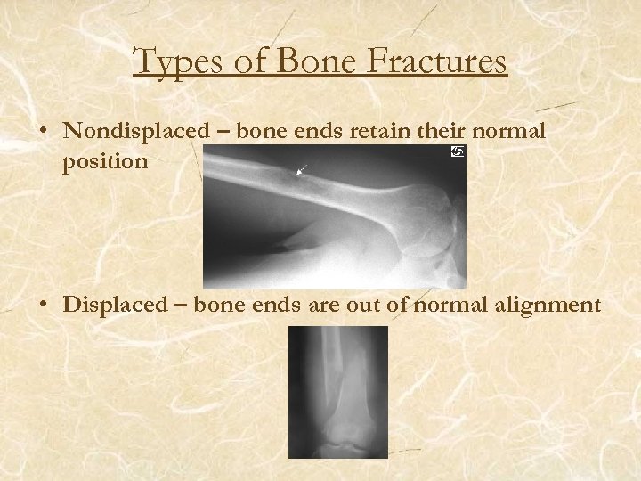 Types of Bone Fractures • Nondisplaced – bone ends retain their normal position •