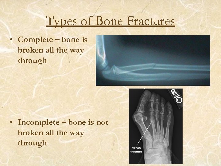 Types of Bone Fractures • Complete – bone is broken all the way through
