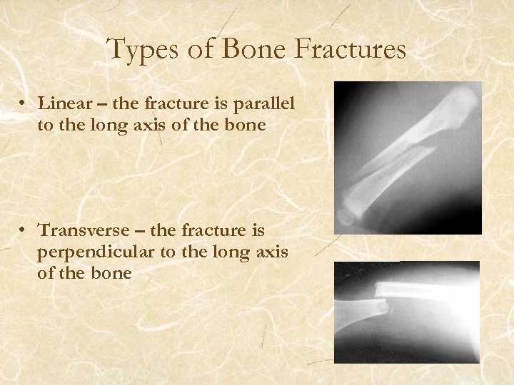 Types of Bone Fractures • Linear – the fracture is parallel to the long