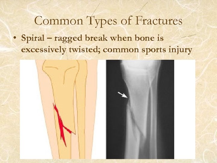 Common Types of Fractures • Spiral – ragged break when bone is excessively twisted;