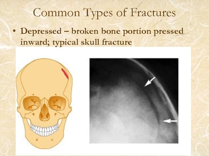 Common Types of Fractures • Depressed – broken bone portion pressed inward; typical skull