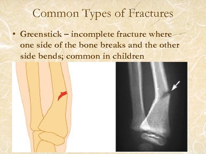 Common Types of Fractures • Greenstick – incomplete fracture where one side of the