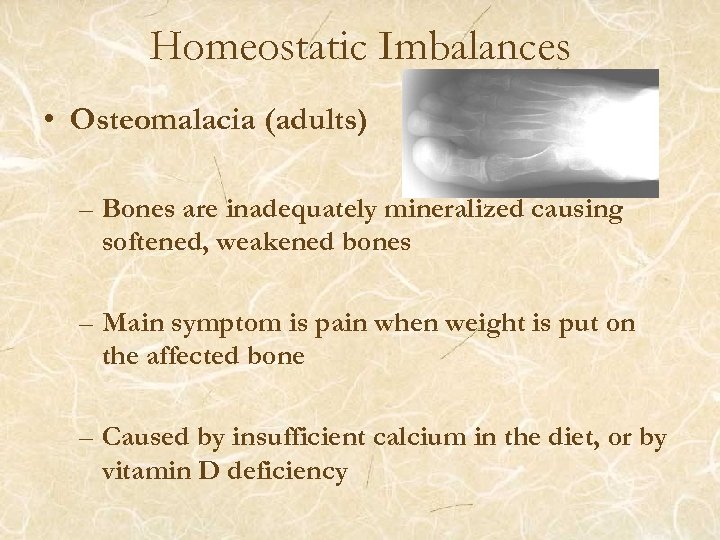 Homeostatic Imbalances • Osteomalacia (adults) – Bones are inadequately mineralized causing softened, weakened bones
