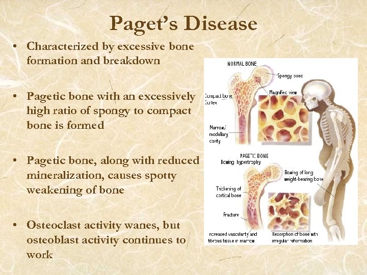 Paget’s Disease • Characterized by excessive bone formation and breakdown • Pagetic bone with