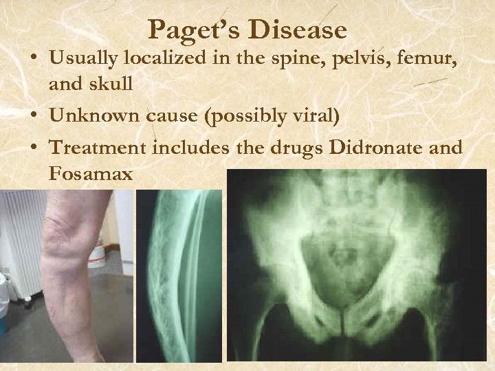 Paget’s Disease • Usually localized in the spine, pelvis, femur, and skull • Unknown