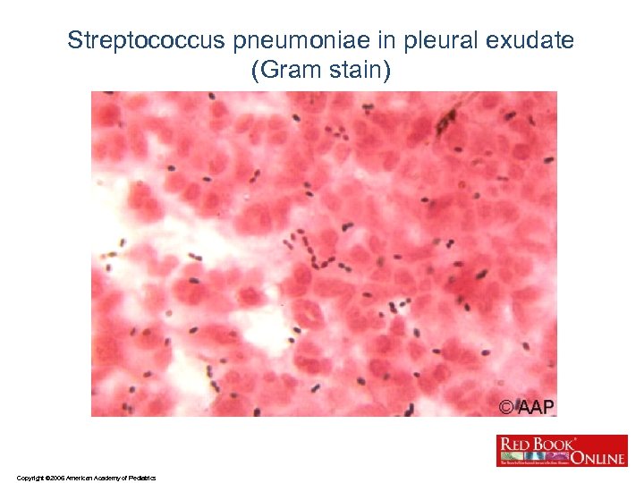 Streptococcus pneumoniae in pleural exudate (Gram stain) Copyright © 2006 American Academy of Pediatrics