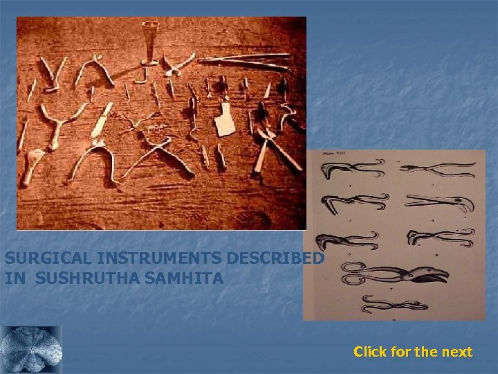SURGICAL INSTRUMENTS DESCRIBED IN SUSHRUTHA SAMHITA Click for the next 