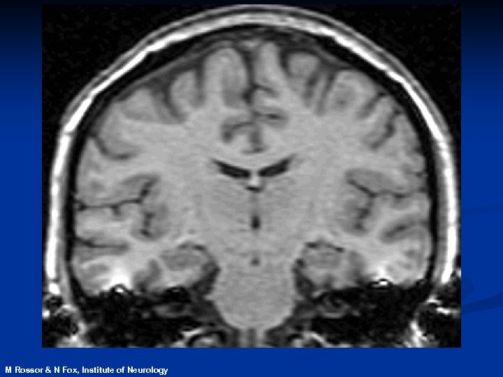 M Rossor & N Fox, Institute of Neurology 