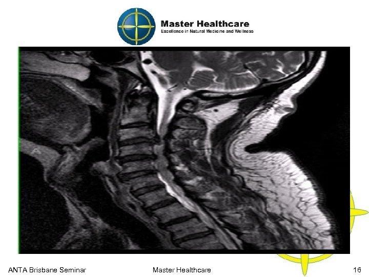 Cervical Functional Anatomy MRI Cervical Region (Disc Herniation) ANTA Brisbane Seminar Master Healthcare 16