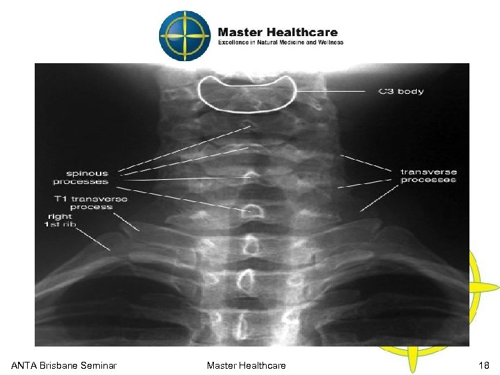 Cervical Functional Anatomy X-Ray (Posterior View) ANTA Brisbane Seminar Master Healthcare 18 