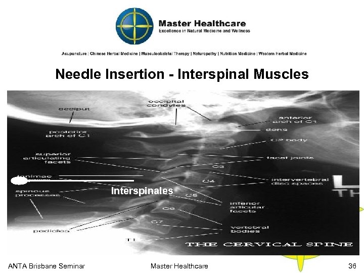 Needle Insertion - Interspinal Muscles Interspinales ANTA Brisbane Seminar Master Healthcare 36 