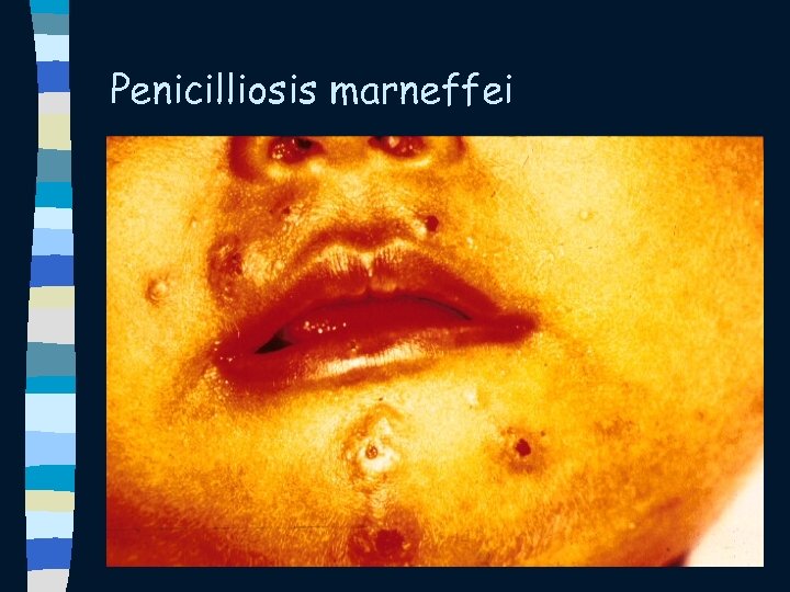 Penicilliosis marneffei 