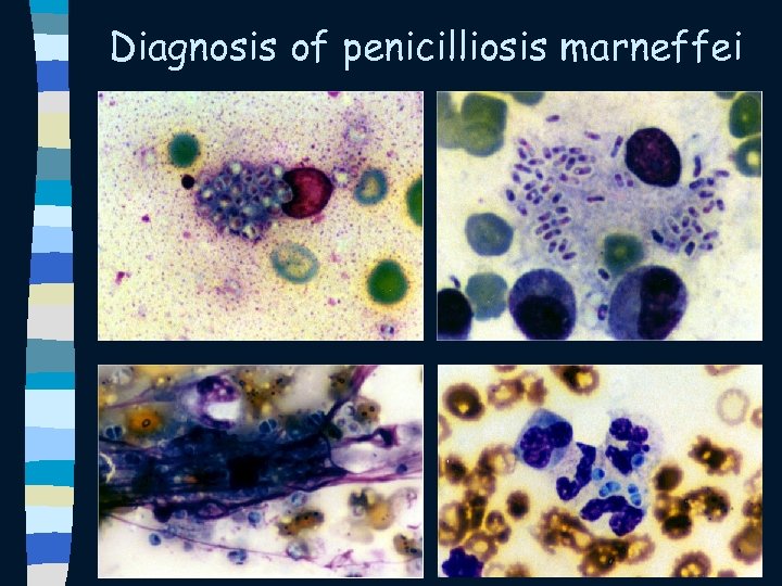 Diagnosis of penicilliosis marneffei 