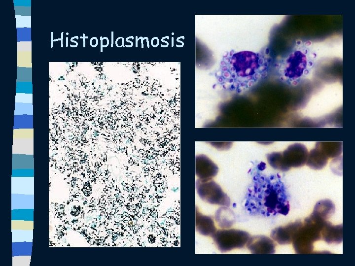 Histoplasmosis 