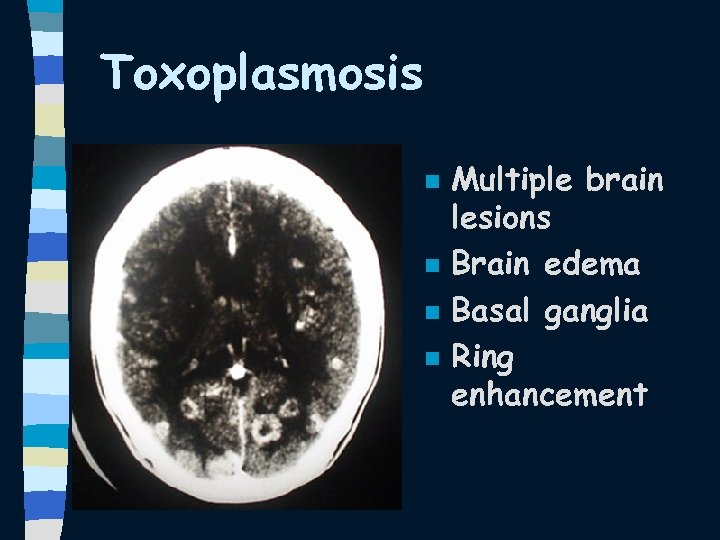 Toxoplasmosis n n Multiple brain lesions Brain edema Basal ganglia Ring enhancement 