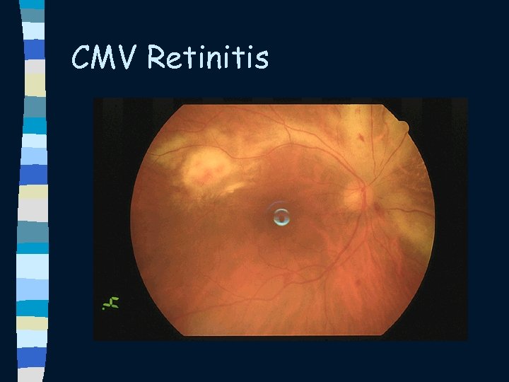 CMV Retinitis 