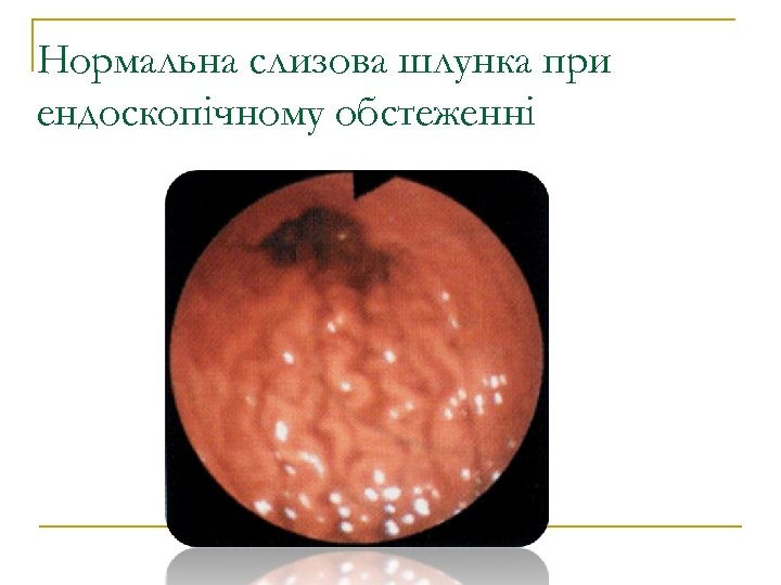 Нормальна слизова шлунка при ендоскопічному обстеженні 