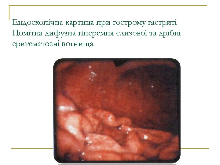 Ендоскопічна картина при гострому гастриті Помітна дифузна гіперемия слизової та дрібні еритематозні вогнища 