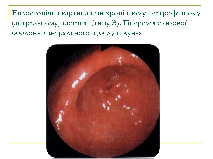 Ендоскопічна картина при хронічному неатрофічному (антральному) гастриті (типу В). Гіперемія слизової оболонки антрального відділу