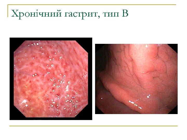 Хронічний гастрит, тип В 