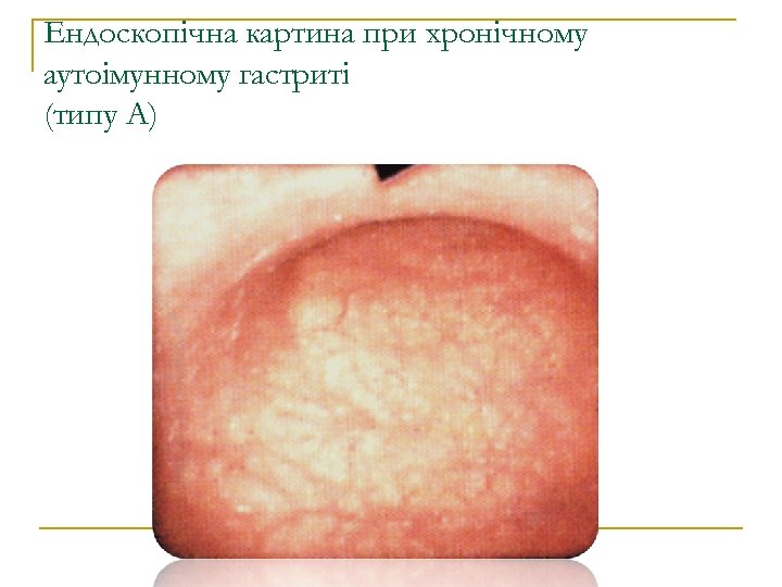 Ендоскопічна картина при хронічному аутоімунному гастриті (типу А) 